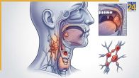 Head And Neck Cancer