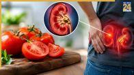 Kidney Stones Causes