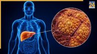 how to identify fatty liver