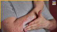Skin Infection