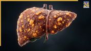 Liver Cirrhosis Ke Lakshan