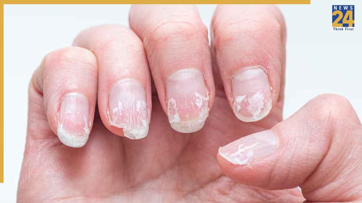 why hands or nails are dry reasons home remedies of cracked hands 