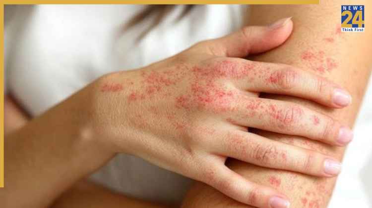 बदलते मौसम में त्वचा पर होती है खुजली? नहाने के पानी में मिलाएं ये 2 चीजें
