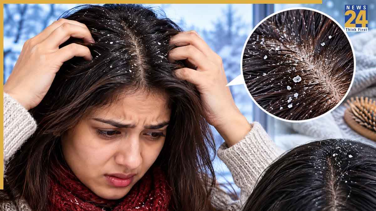 Winter Dandruff Causes And Treatment