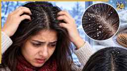 सर्दियां आते ही बालों में बढ़ गई है रूसी? अपनाएं ये आसान उपाय!