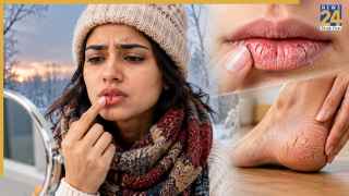 सर्दियों में फटने लगते हैं होंठ और एड़ियां? जानिए कैसे मिलेगी राहत