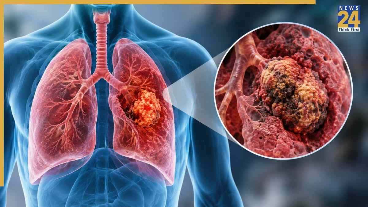 Lung Cancer Symptoms