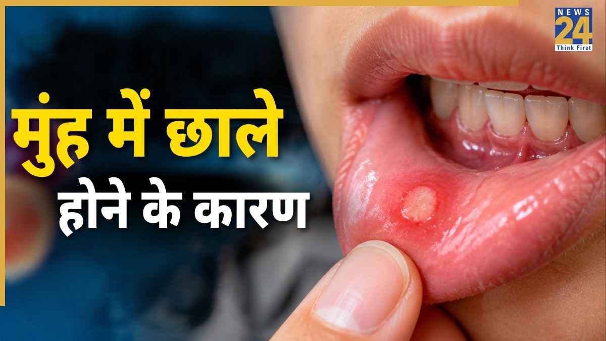 mouth ulcers causes