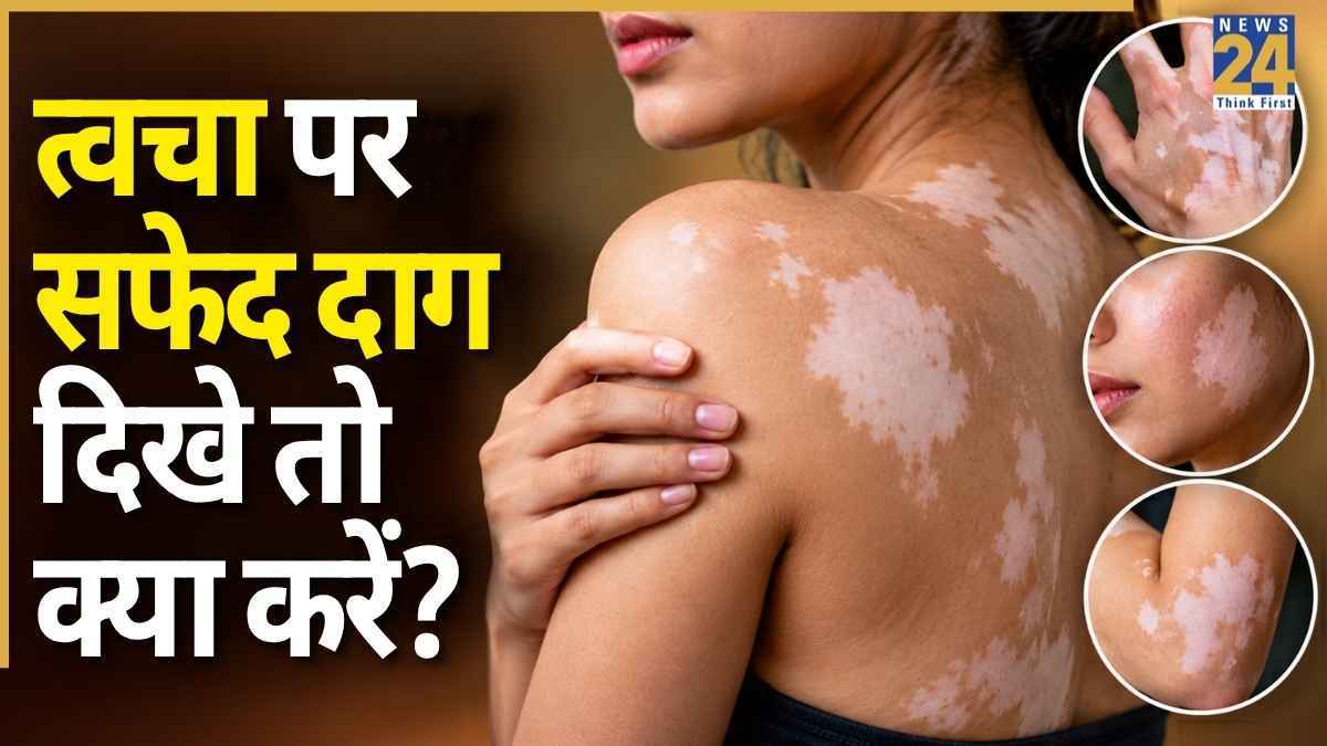 क्या विटिलिगो का कोई इलाज है या नहीं, डॉक्टर ने बताया शरीर पर सफेद दाग दिखें तो क्या करना चाहिए